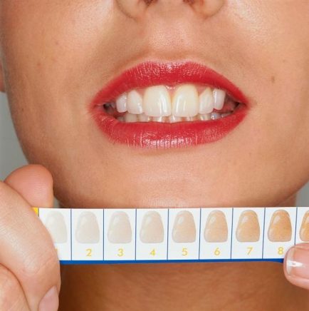 Zahnaufhellung: Mit welchem Ergebnis kann ich rechnen?
